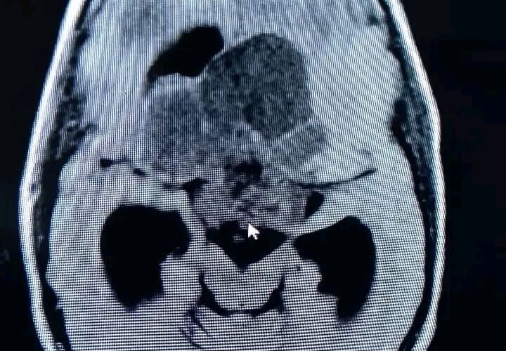 Realizan exitosa operación de tumor cerebral en Hospital Pediátrico de Matanzas