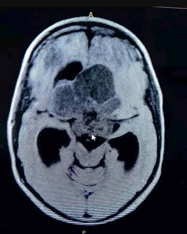 Realizan exitosa operación de tumor cerebral en Hospital Pediátrico de Matanzas